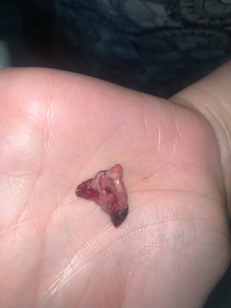 TW GRAPHIC PHOTO- missed miscarriage or clot?