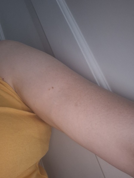 What is this rash on my arm