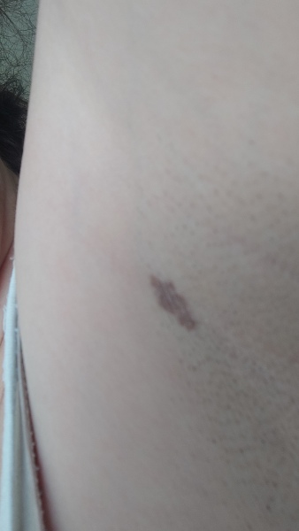 Worried about this mole