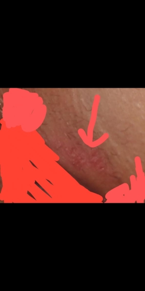 WORRIED ABOUT A SORE