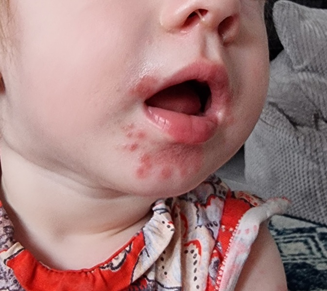 Could this be HFM or Impetigo?