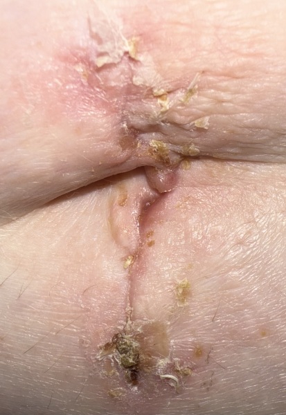 Nurse or doctor advice please on incision