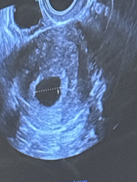 TMI Photos - Brown discharge 6/7 weeks. 