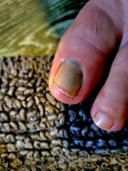 Will they remove my toenail?