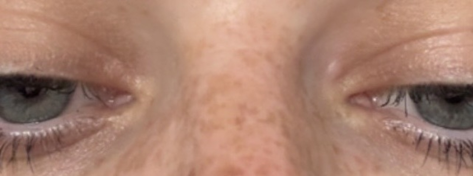 Anyone know what these small lumps are on my eyelids?