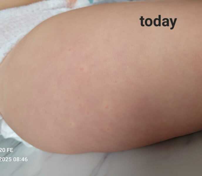 What are these spots on toddler?