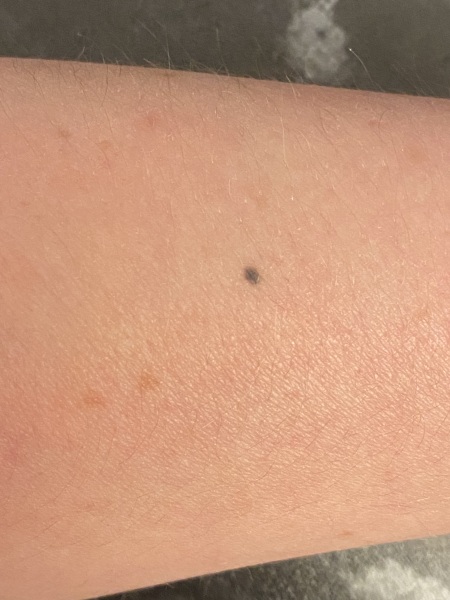 Suspicious mole due to change in colour
