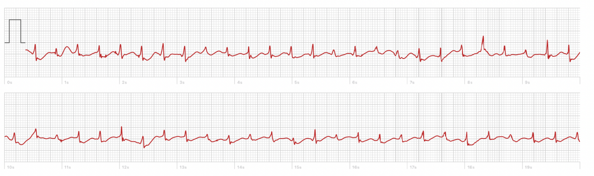 Apple Watch ECG - SVT?