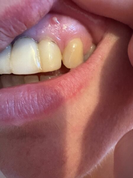 Gum lesion?