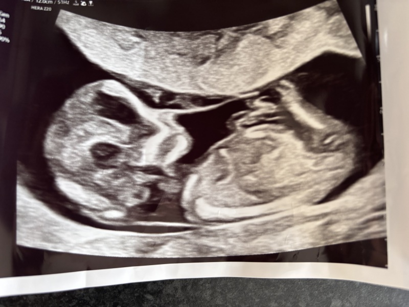 Boy or Girl?