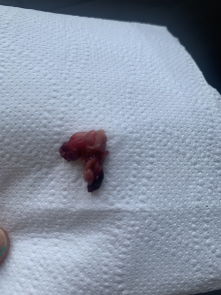 TW GRAPHIC PHOTOS- Misscarriage or blood clot?