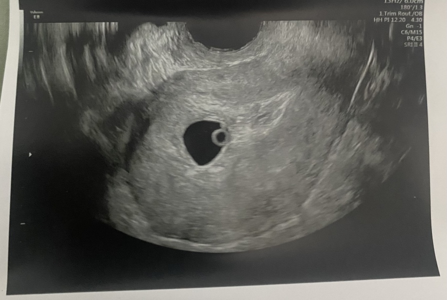 Measuring behind on reassurance scan, told no fetal pole but convinced i can see it!