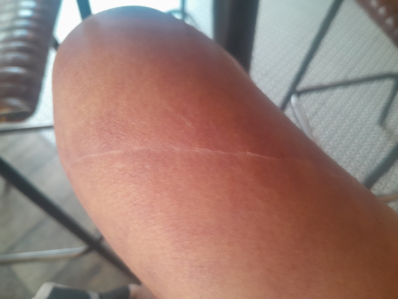 To ask what’s the most ridiculous injury you’ve given yourself?