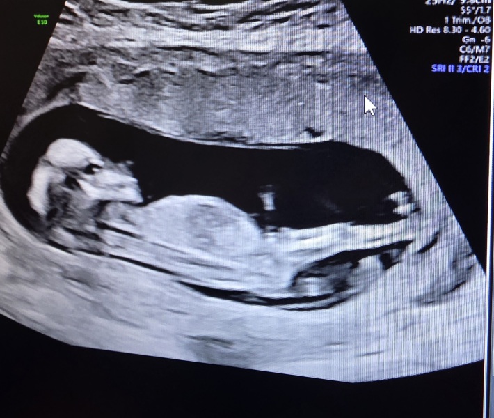 13 week scan. Boy or Girl?