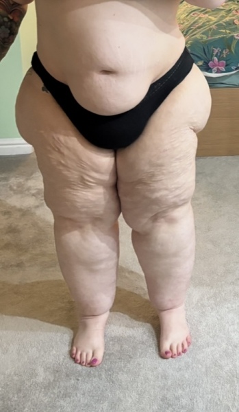 Mounjaro and lipoedema?