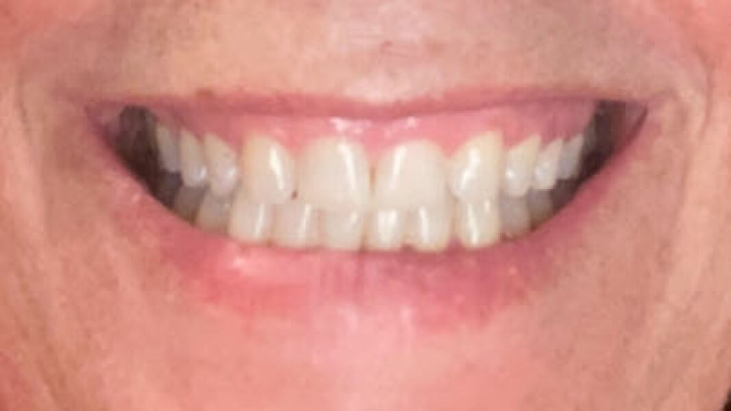 Missing lateral incisor