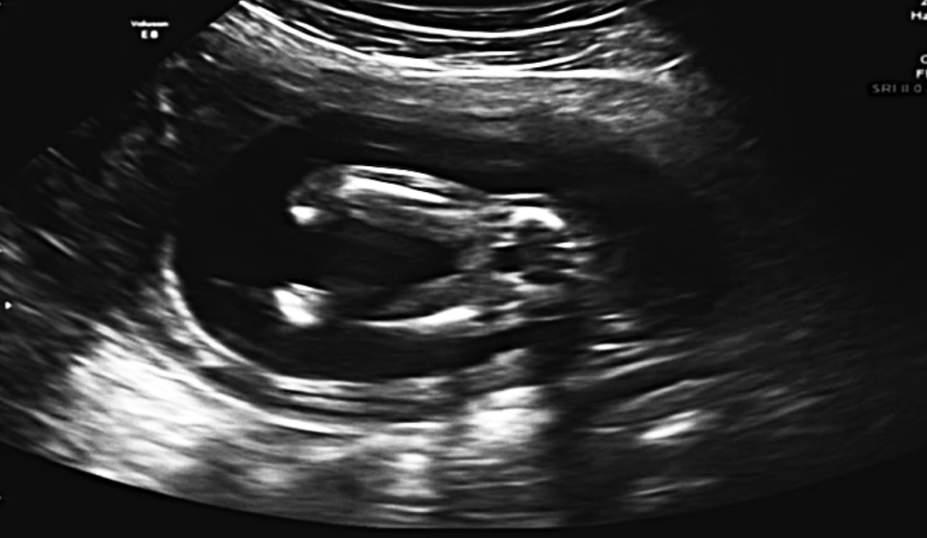 Can a 17 week boy gender scan be wrong?