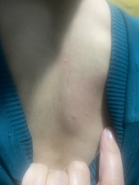 38 weeks pregnant and think DS has chickenpox