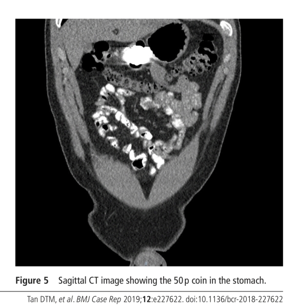 2 year old daughter swallowed a 50p coin !!!