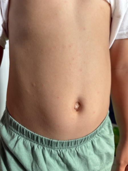 Does this look like the start of chickenpox?