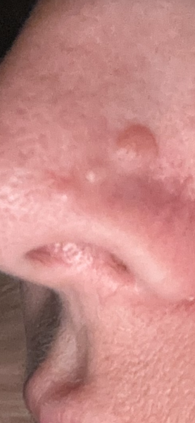 3 ‘moles’ in a line on nose