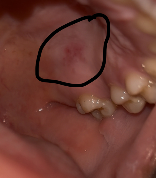 Gum cluster