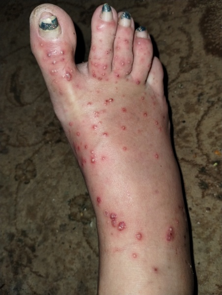 Hand, foot and mouth plus psoriasis