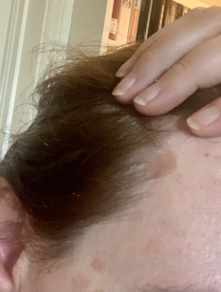 Seborrheic Keratosis miracle cure