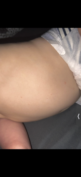 Was this chicken pox?!