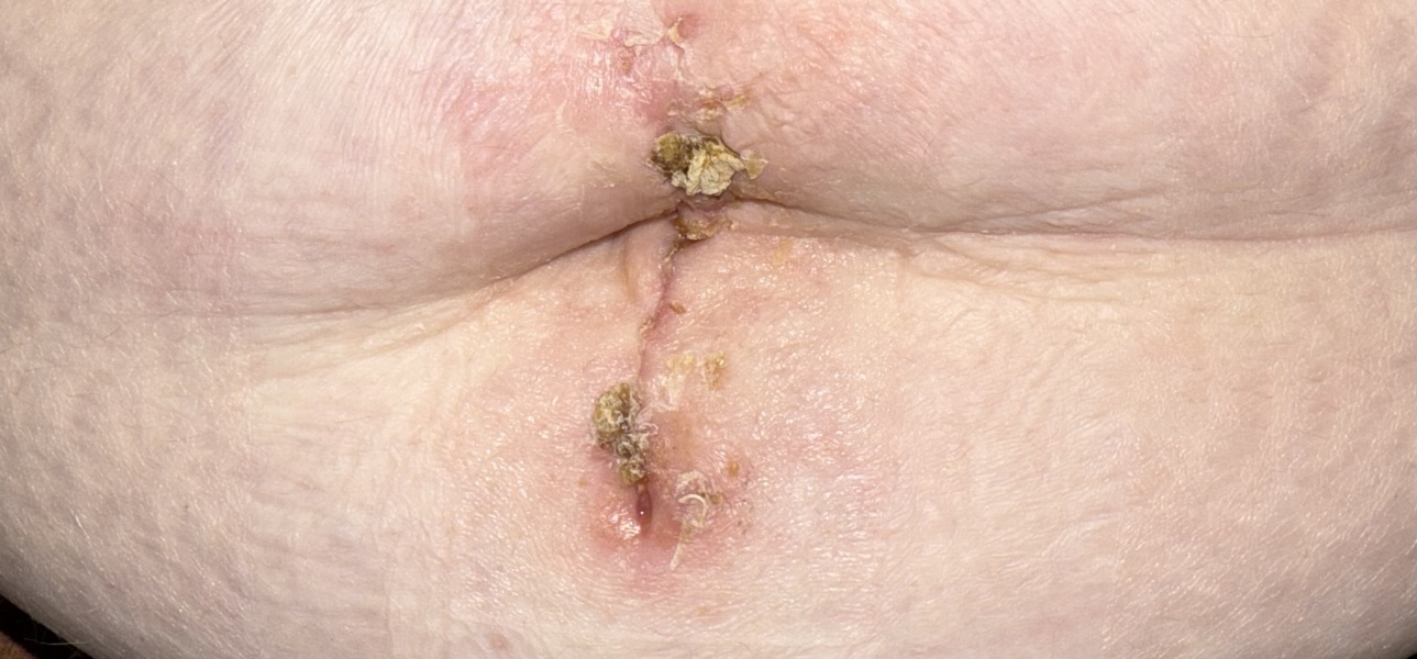 Any doctors or nurses able to review my incision?