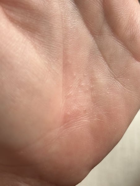 Is this actually dermatitis? Sooooo itchy!