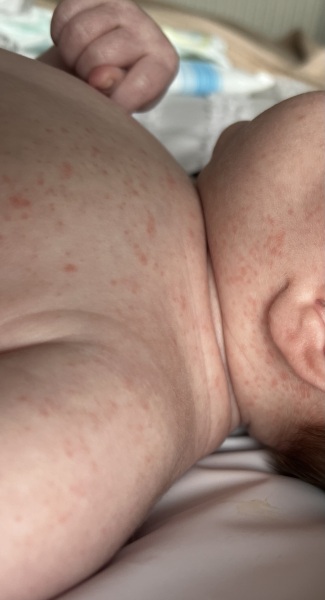 Heat Rash or CMPA?