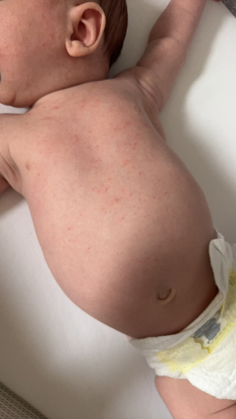 Rash on 5 week old