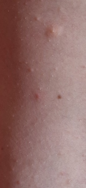 Is this chicken pox?