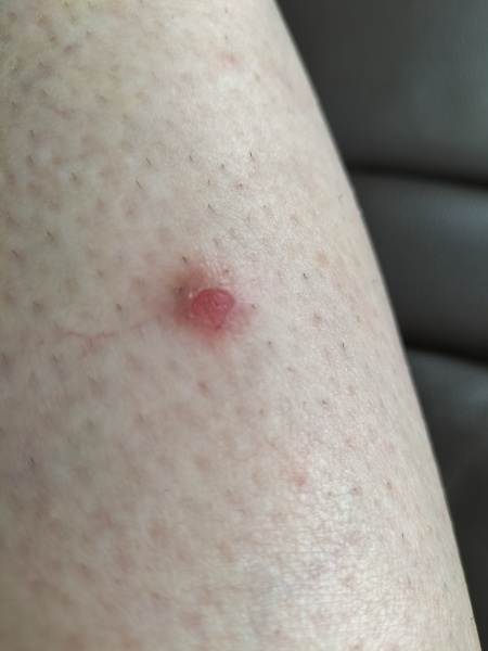 What is this sore little scab?!