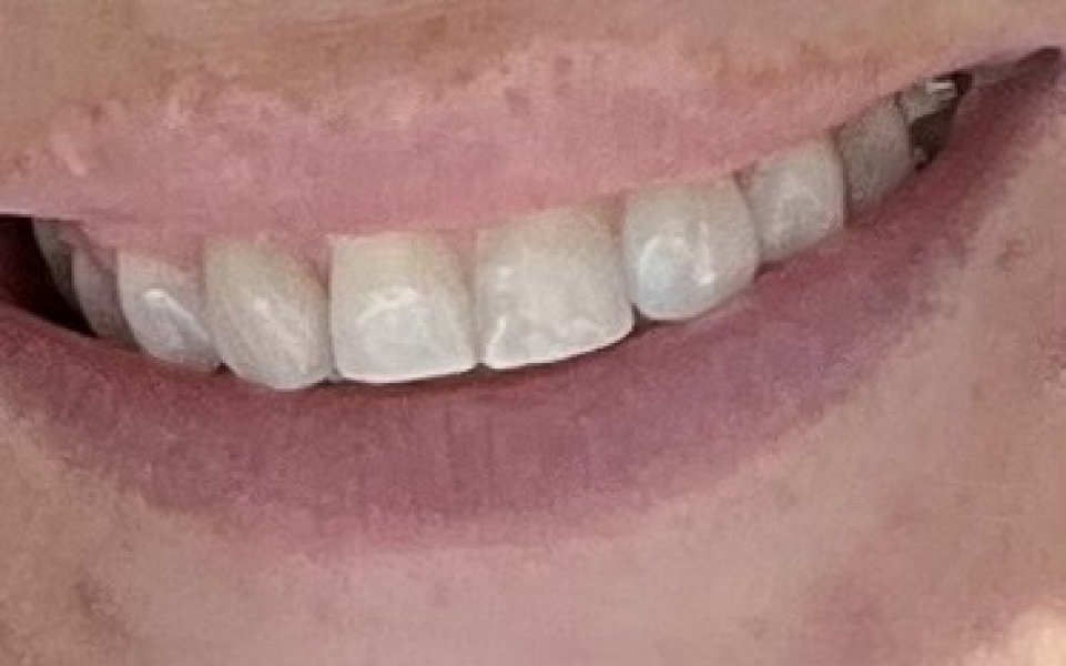 Missing lateral incisor