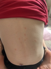 Rash on my son’s skin