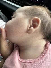 Does anyone know if this rash looks like CMPA?