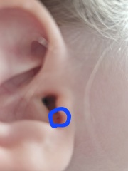Blocked pore(?) in 4 year old ear