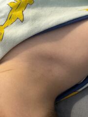 Is This Chicken Pox?