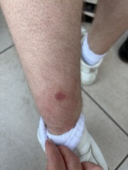 What is this on partners leg?