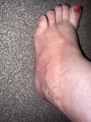What is wrong with my foot?  - warning - Horrible picture