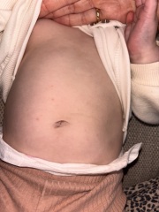 Does this look like chicken pox?