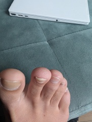 Toenails falling off and bulbus tip (pics attached)