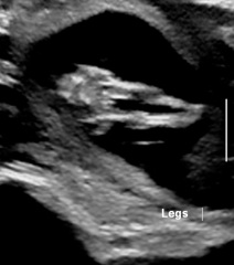 Boy or girl? 12 week scan