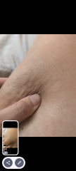 Cellulite or lipedema?