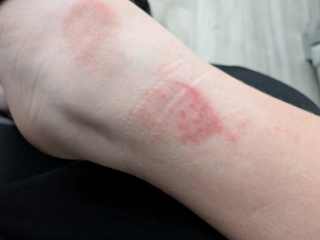 Rash on DS's leg - don't know what else to try....any ideas please? [pic included]