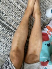 White blotchy gradual tan, please help!
