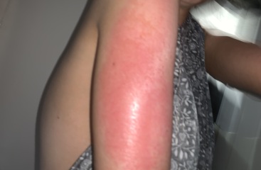 HELP!!!! Veet burn