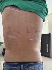 Skin patch testing … ( photo ) anyone have input ?
